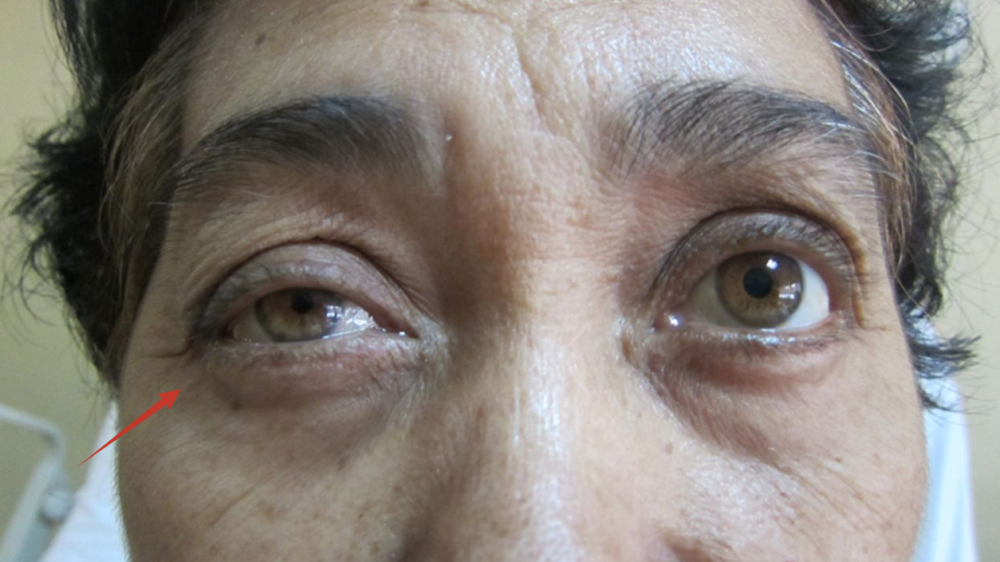 肺部有癌,脸上先知!老烟民脸上出现这个"信号",真要小心了