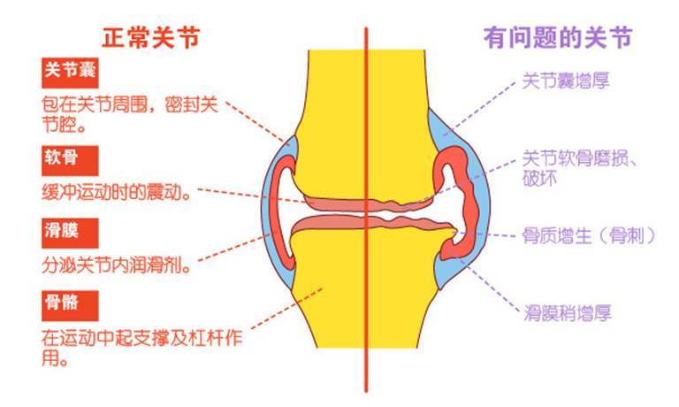 关节积液是什么原因引起的 为什么会反复发作