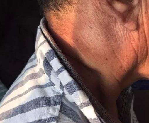 淋巴结核是什么?淋巴结肿大是什么?两者一样吗?