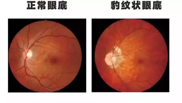 近视600度以上的眼底图片看完深思你离高度近视有多远