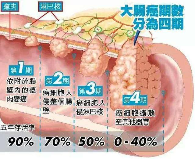 直肠癌保肛中心:直肠癌二期治愈率高不高?能活多久?