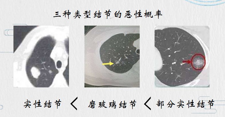 肺结节大小 腾讯网