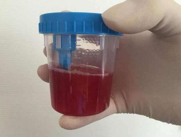 尿毒症并非"突如其来",不论男女,尿液若有这"3现象",别不当回事!