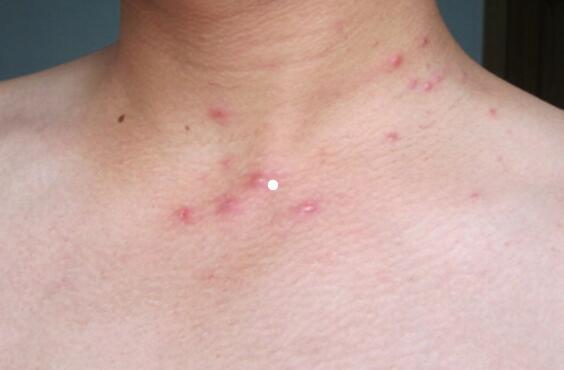 的全身瘙痒,多方检查治疗无效, 因她曾输过血,后一查艾滋病毒抗体阳性