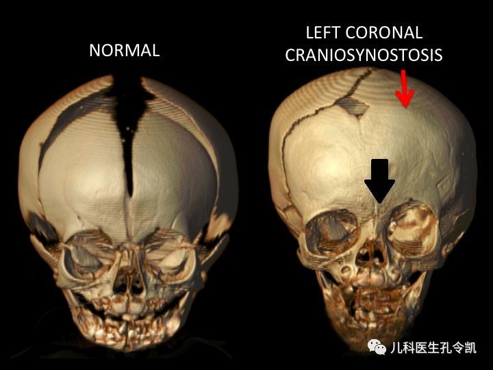 真實照片如下,這個寶寶時左側冠狀縫閉合,能看出左側前額比較平(仔細