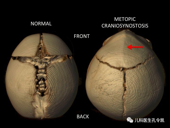 这样的孩子可能有脑积水佝偻病和呆小病,发现囟门关闭异常,应立即带