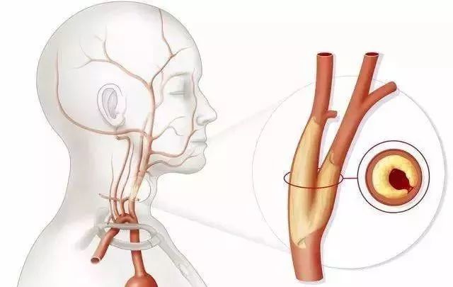 颈动脉斑块3 5 1 5mm对人体的危害有多大 真的会得脑梗吗 腾讯新闻