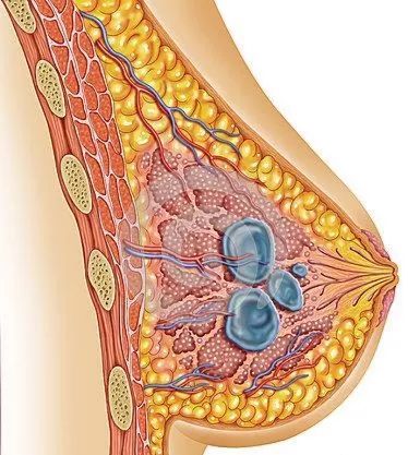乳腺囊肿是女性常见乳房疾病,占乳腺疾病的7%左右,好发于30-50岁女性