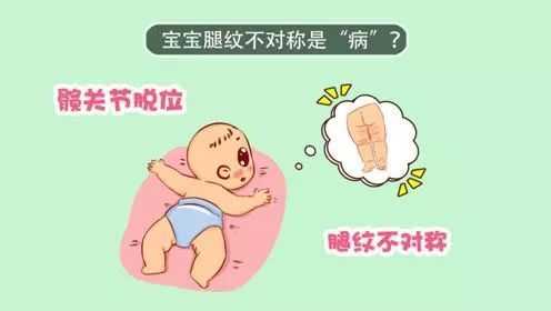 警惕!宝宝腿纹,臀纹不对称,可能是髋关节脱位