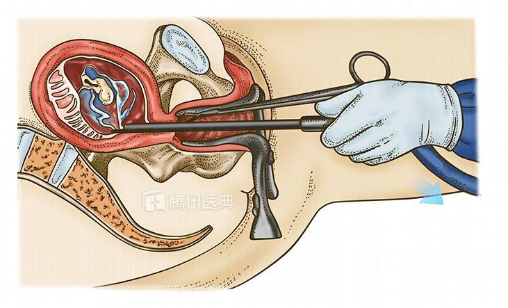 钳刮术是妊娠10～14周后人工流产的首选方法,如今配合麻醉,药物流产