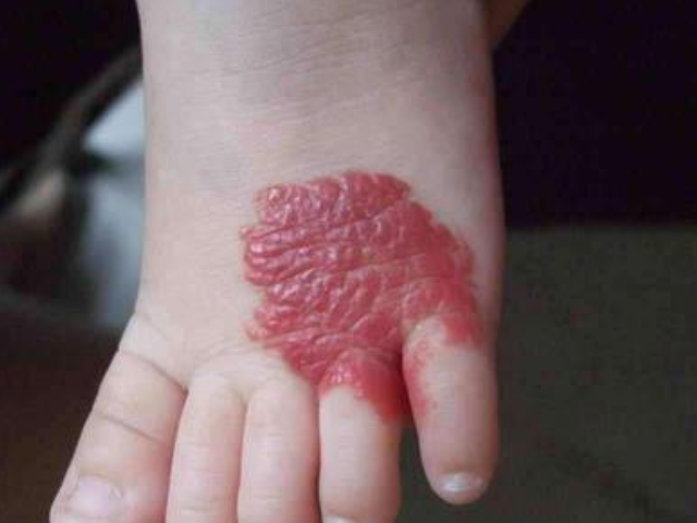 胎记真的是前世死亡的致命伤吗都来看看到底是什么原因吧别再迷信了