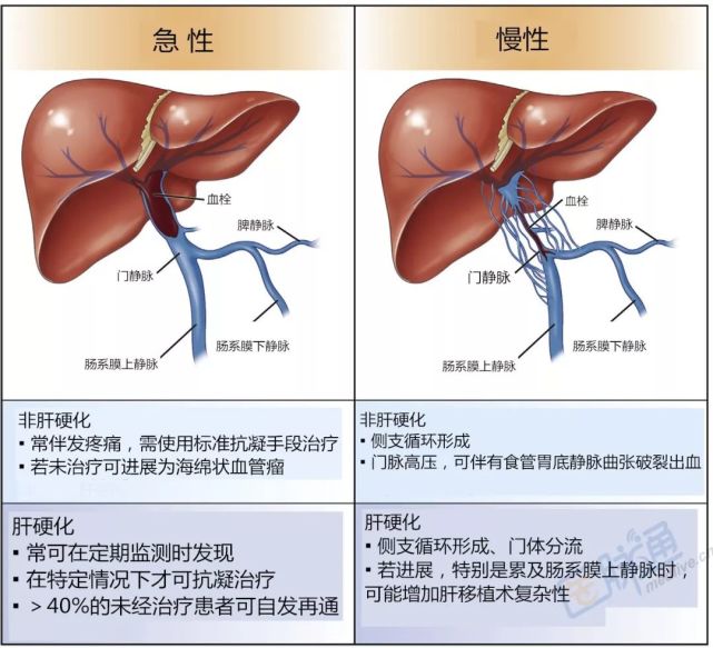 高分综述 详解门静脉血栓形成 静脉血栓形成 海绵状血管瘤 门静脉血栓形成 肝硬化