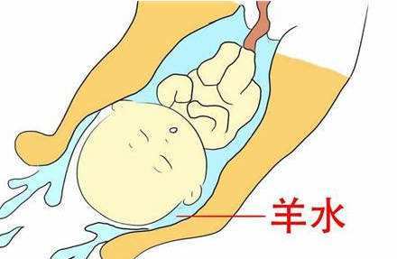 破裂,这时候就需要医护人员通过阴道,用一根细长的钩子,人为将羊膜囊