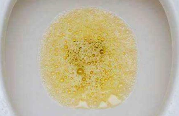 尿毒症并非"突如其来",不论男女,尿液若有这"3异常",不要大意了!