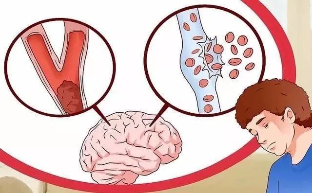 脑动脉硬化 腾讯网