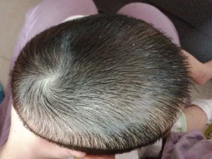 像舟状头,三角头等头部变形的特别奇怪的需要尽快就医排除疾病