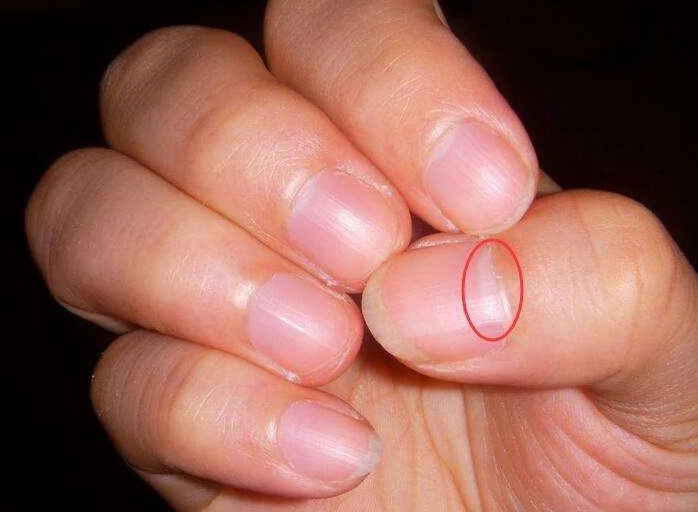 指甲上的小月牙代表什么真的越多越健康越少的越不健康吗