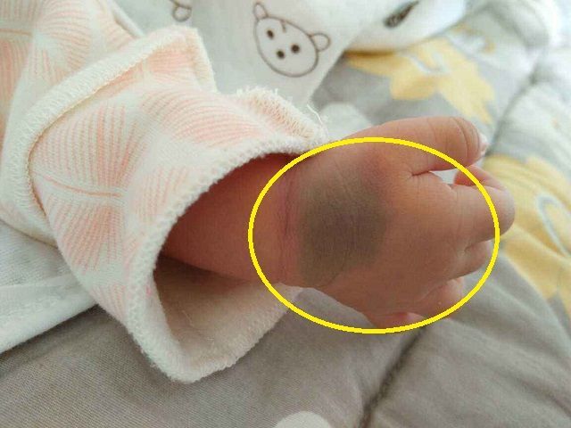 不想宝宝身上长胎记,孕期这4件事忍住别做,颜值会跟随他一辈子