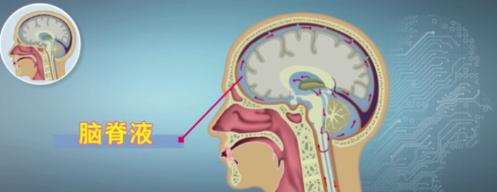 "老年痴呆"也有可能是正常压力脑积水引起的!