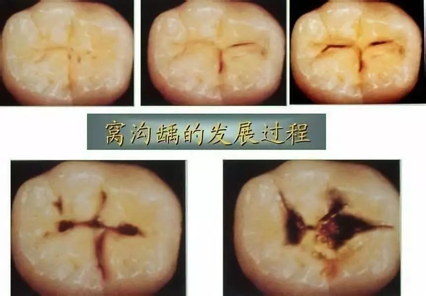 口腔科普牙齒出現神秘黑線你的牙危險了