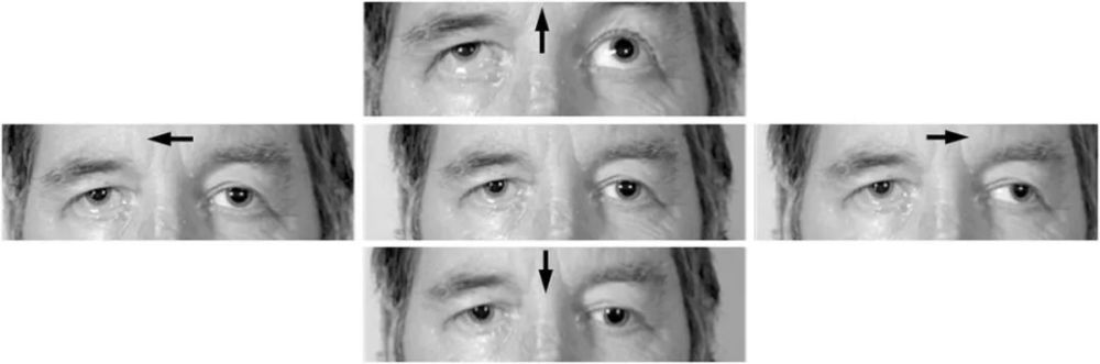 该患者因右面部神经麻痹,右三叉神经麻痹和共济失调入院.