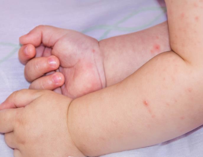 婴儿大便中带血丝可能是牛奶蛋白过敏父母切不可忽视