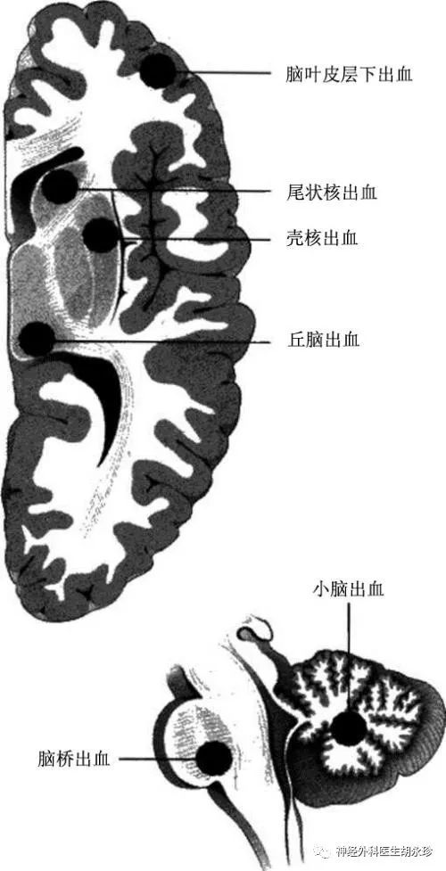 脑出血病人 为什么预后差 腾讯新闻