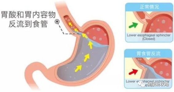 吃东西反酸是怎么回事？胃酸过多用什么中和？