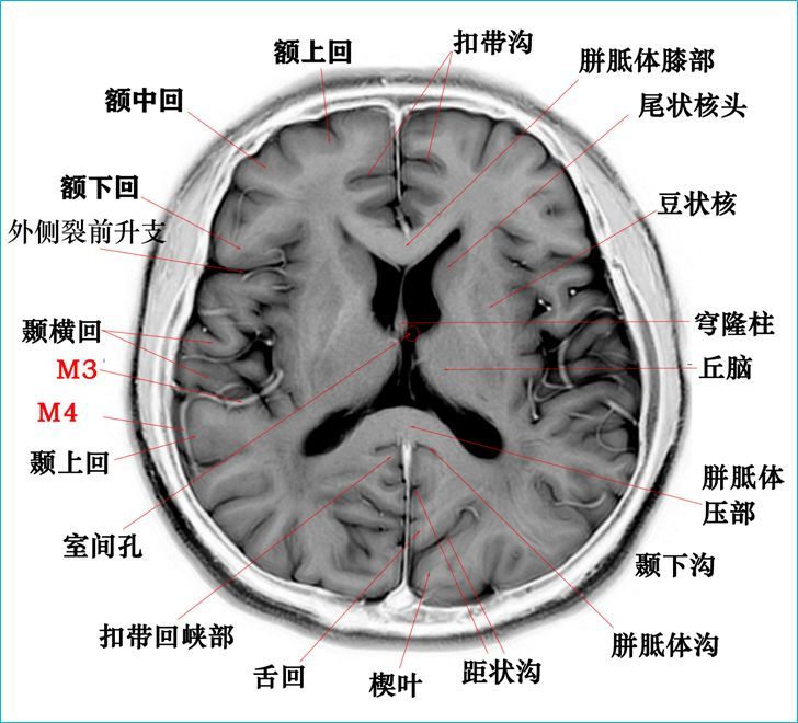 必收藏这个高清颅脑断层解剖图谱实在太棒了磁共振大体标本