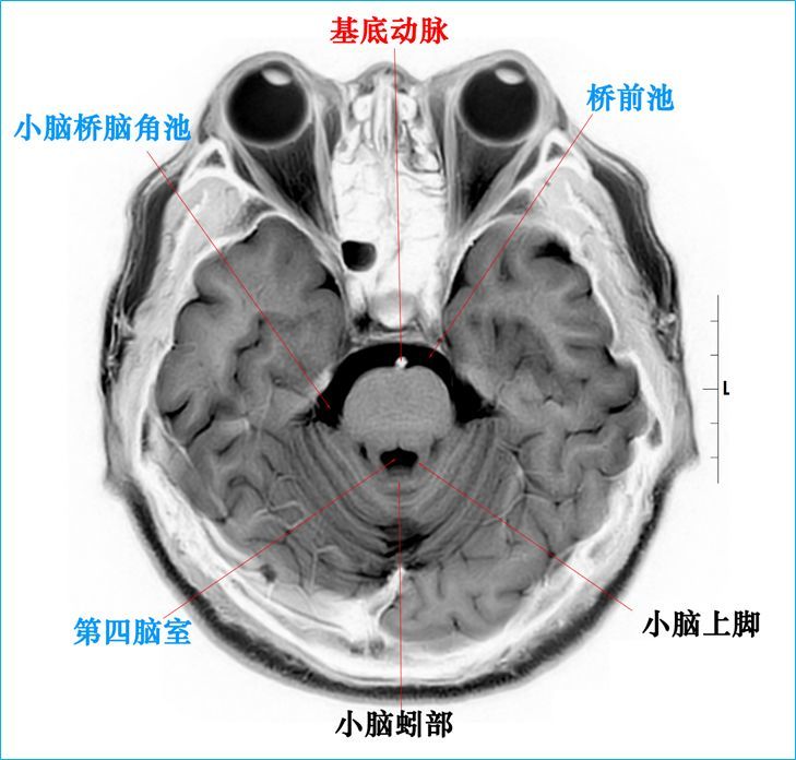 大脑半球标本连续切片断层解剖