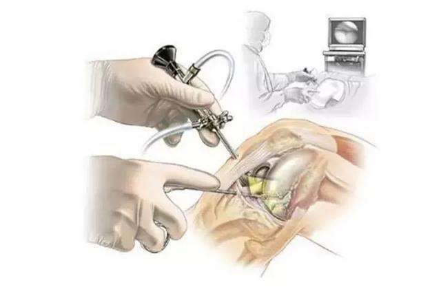 关节镜手术治疗半月板,术前需做什么准备?