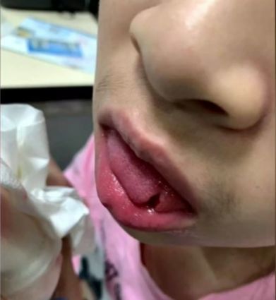 小孩补牙导致舌头被割破,家长要求赔10万,合理吗?