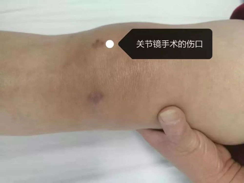 缝合的伤口怕裂开吗半月板缝合术后病人的疑问解答