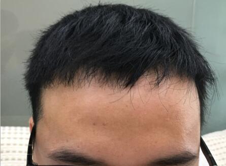揭秘:额头两边掉头发的原因,m型脱发怎么办?