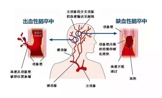 脑卒中的危害有哪些?