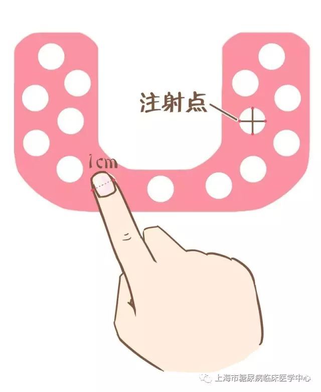 正确选择胰岛素注射部位