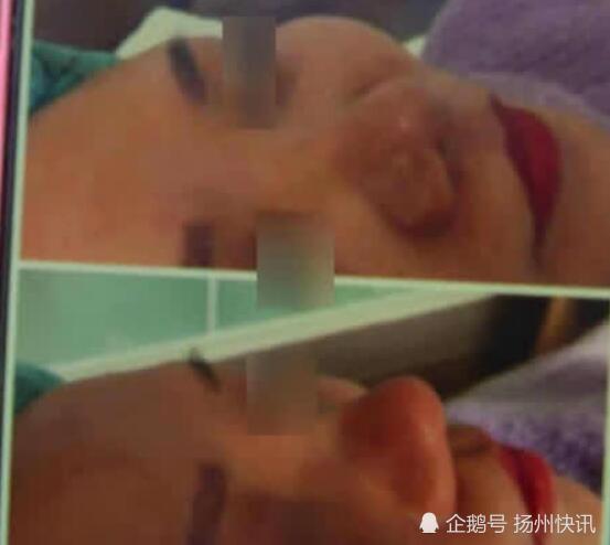 后悔 爱美女子在快捷酒店里接受 微整形 腾讯新闻