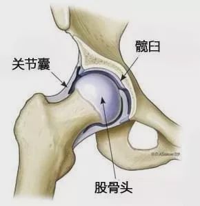 股骨頭壞死有哪些早期症狀是不能忽視的?