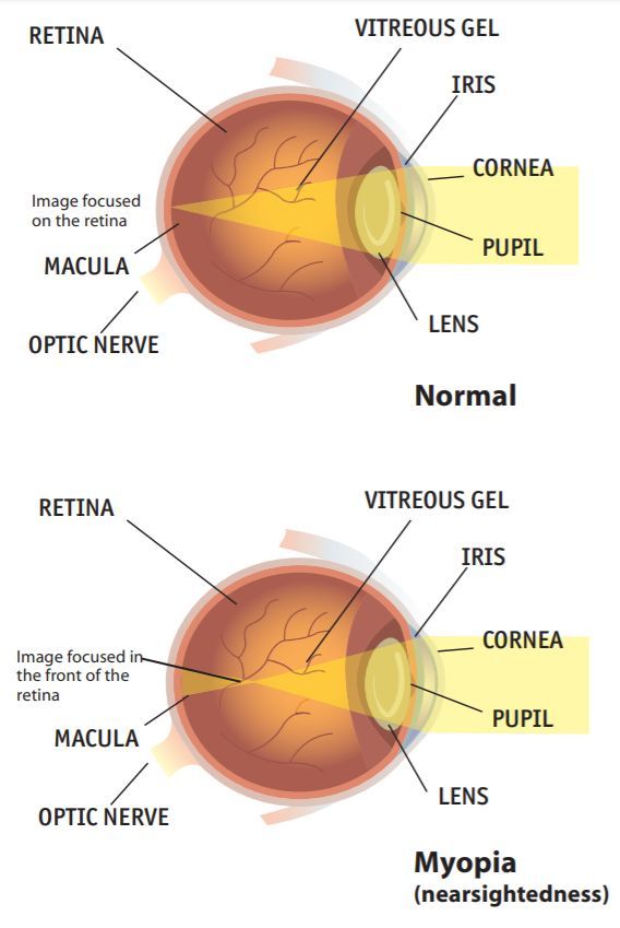下活动,有助于防止或延迟轴性近视的发生