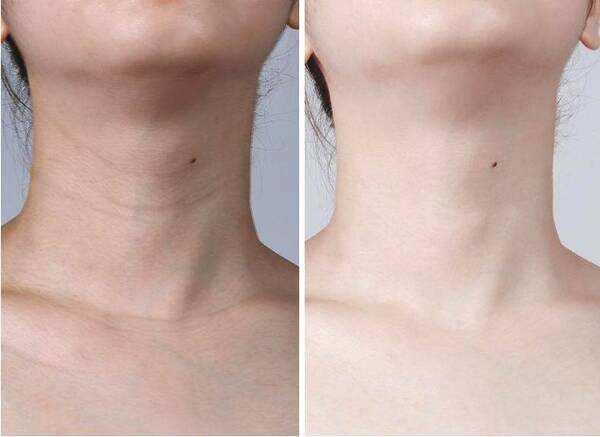 王菊用超声刀去颈纹,痛到怀疑人生!不开刀淡化颈纹小技巧送给你