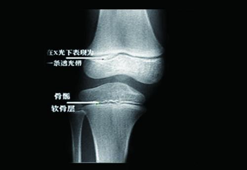 它会随着年龄的增长而逐渐变短,当骨骺与干骺端的软骨完全骨化后就