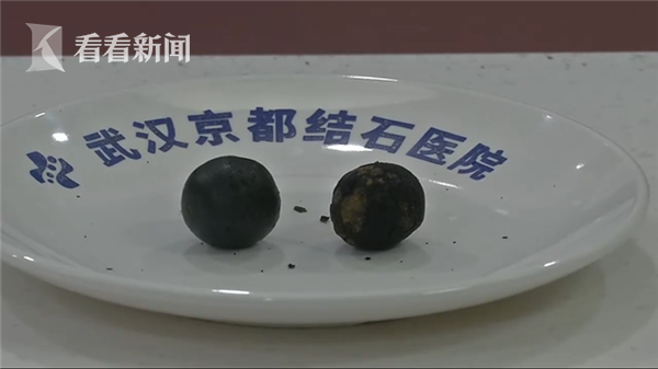 小伙明知有病却懒得管医生取出双胞胎结石让他心有余悸