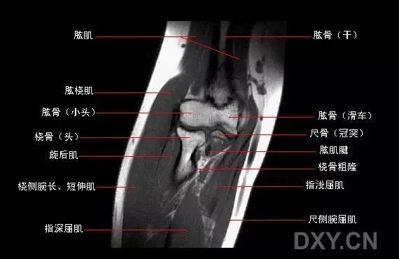 它位於腕關節的尺側,包括腕關節尺側伸肌腱鞘,橈尺背側韌帶,三角纖維