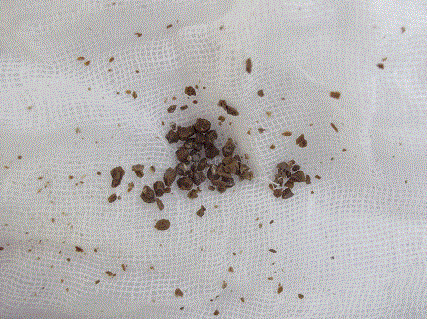 不用慌肾结石是可以自己排出体外的