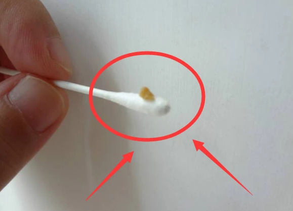 耳屎为啥会湿湿油油的多半是3因素在作祟快自测