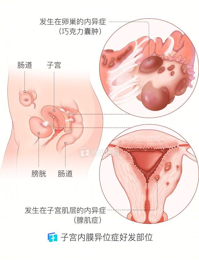 女人下腹痛没你想的那么简单 宫外孕 流产感染 大意了都会致命 Qtc Care