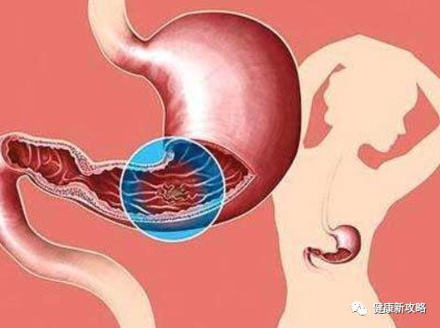 70岁慢性萎缩性胃炎伴肠化,胃病10年,如何救治