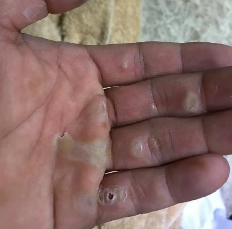 奥运冠军的心酸石智勇晒手掌照片满是厚厚一层老茧