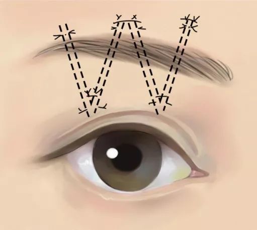 1,针对不太严重的提肌无力,常选择提上睑肌折叠或缩短术,通过折叠或