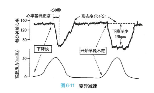 来源于妇产科学第九版晚期减速在宫缩之后出现一个缓慢的胎儿心率的